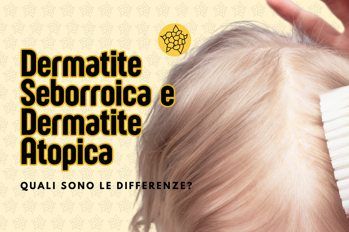 dermatite seborroica e dermatite atopica, differenze